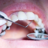 Zaujalo nás. Ako zubné plomby, korunky a implantáty môžu doslova vyskratovať váš mozog
